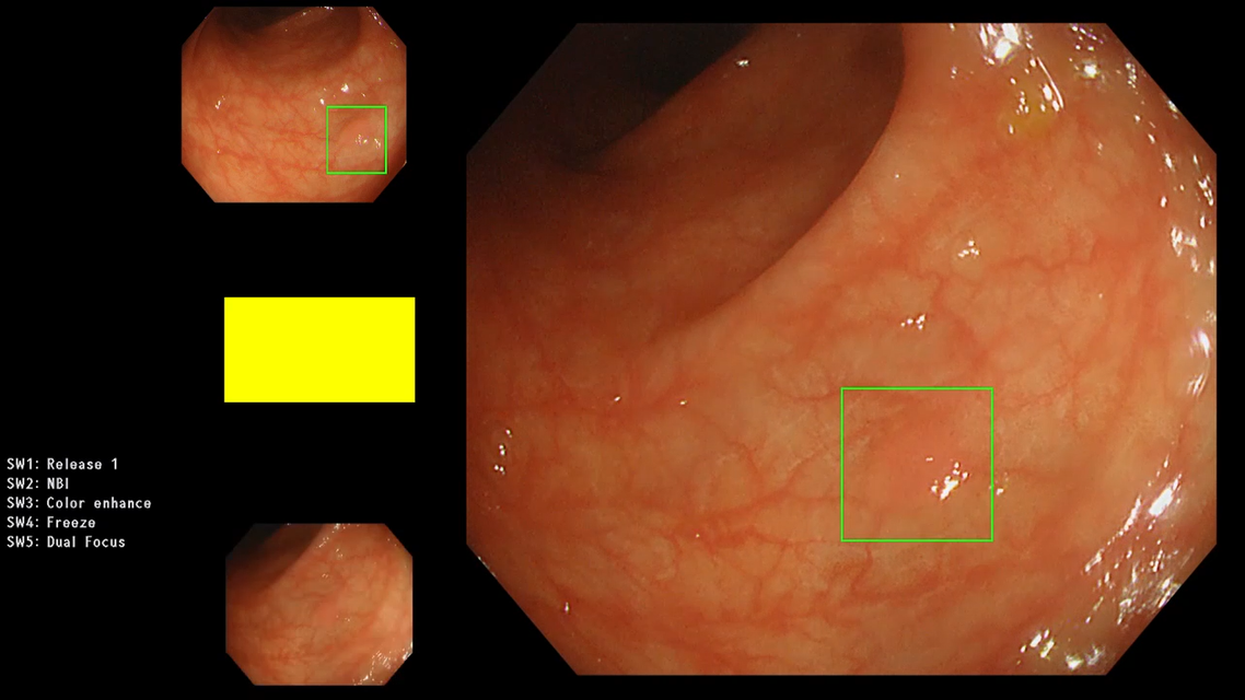 EndoAim_detection