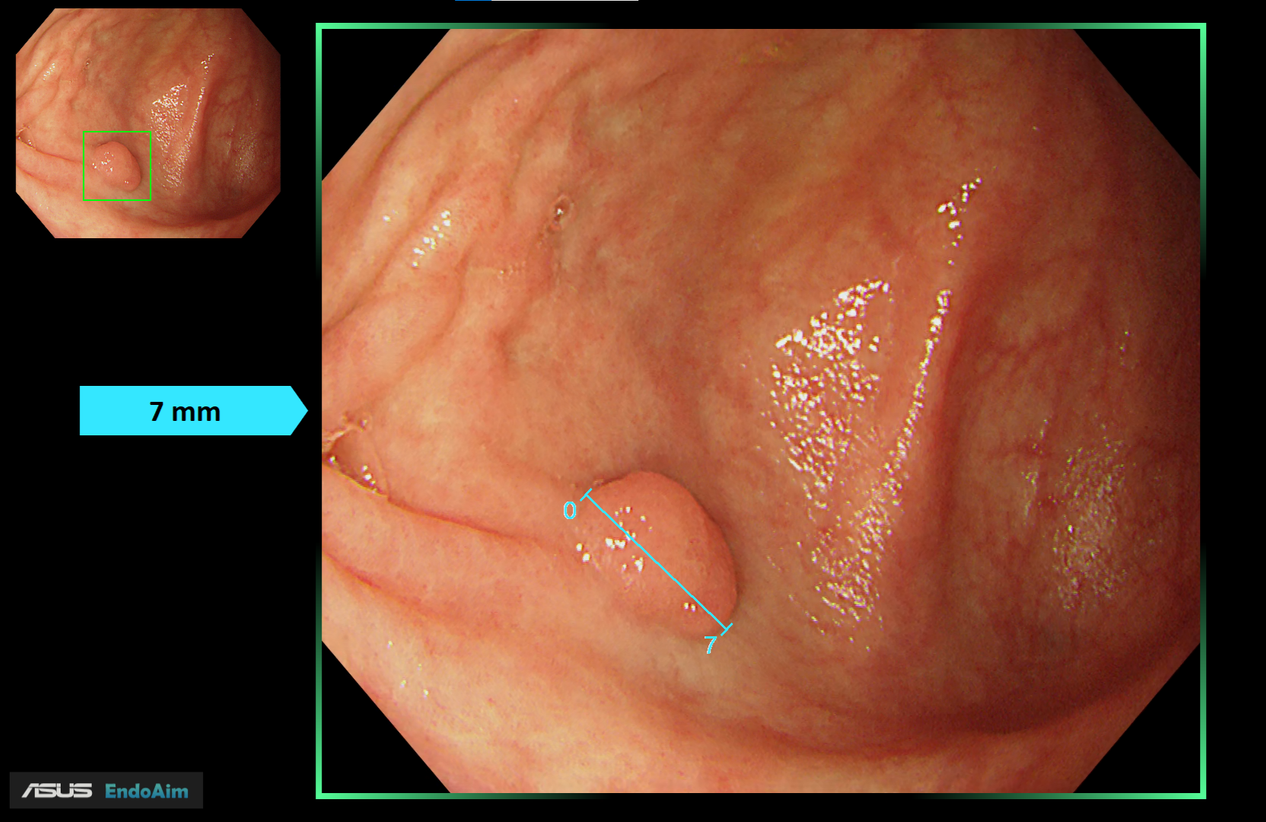 EndoAim Endoscopy Solution, an AI medical imaging solution that assists doctors in detecting polyps to prevent their development into colorectal cancer.