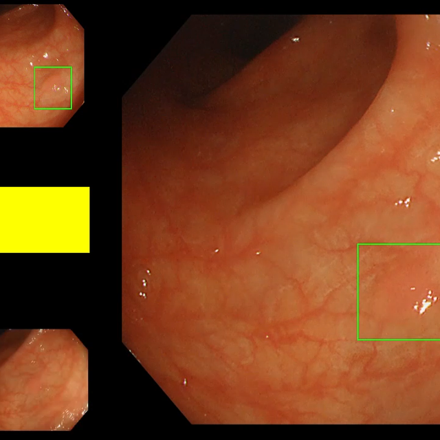 EndoAim_detection
